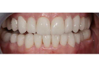 After image